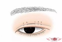 双隐形双眼皮术后感染了怎么办 给你带电的双眼
