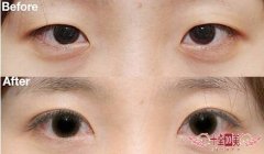 割欧式双眼皮化脓怎么办 让你立刻拥有瓜子脸