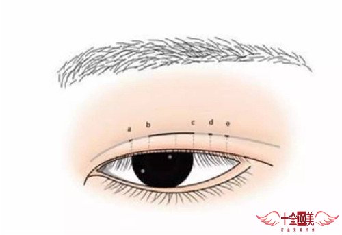 微调双眼皮恢复太窄怎么办 让你的眼睛更有魅力