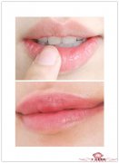 纹唇有什么后遗症吗