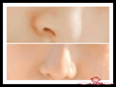 鼻翼缩小手术的方法有哪些