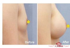 正规假体隆胸技术效果好吗 使每个女人信任