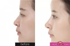 手术假体隆鼻效果可靠吗 实现鼻子的更加挺翘