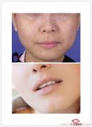 什么人适合做面部吸脂减肥