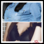 乳房下垂矫正手术会不会有副作用