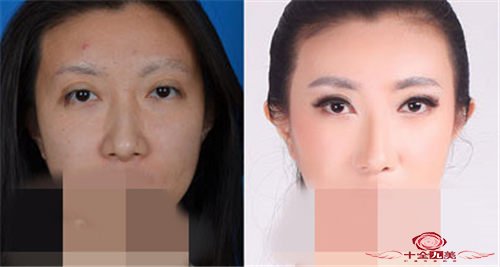 假体垫鼻子鼻整形手术后多久出效果 高挺与保障一举二得 