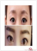 双眼皮手术后对身体会有影响吗？