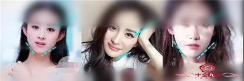 自体脂肪鼻翼填充效果及恢复时间 造就火辣美丽迷人