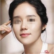 达拉斯4D隆鼻后效果如何 实现翘鼻的高挺好看