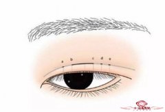 翘睫全切双眼皮价格多少钱 价格由哪些确定