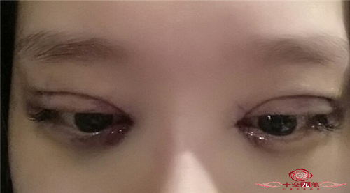 假体鼻部整形会达到什么效果 重现姐妹们的柔和感