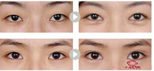假体鼻整形手术效果可以保持多久 实现鼻型的挺拔
